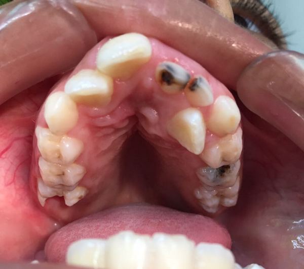 Brasil tem apenas uma escova de dente disponível por ano, por família