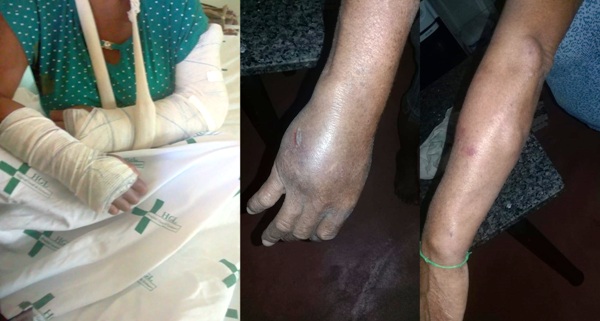 Mulher tem os dois braços quebrados a pauladas no Areal de Regência