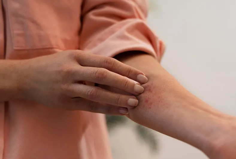 Picadas de insetos: como prevenir e agir em casos de reação alérgica