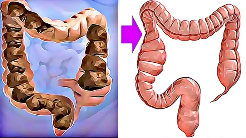 10 sintomas de câncer de intestino. Fique atento