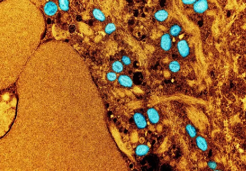 Linhares registra primeiro caso de Mpox. Paciente é um homem