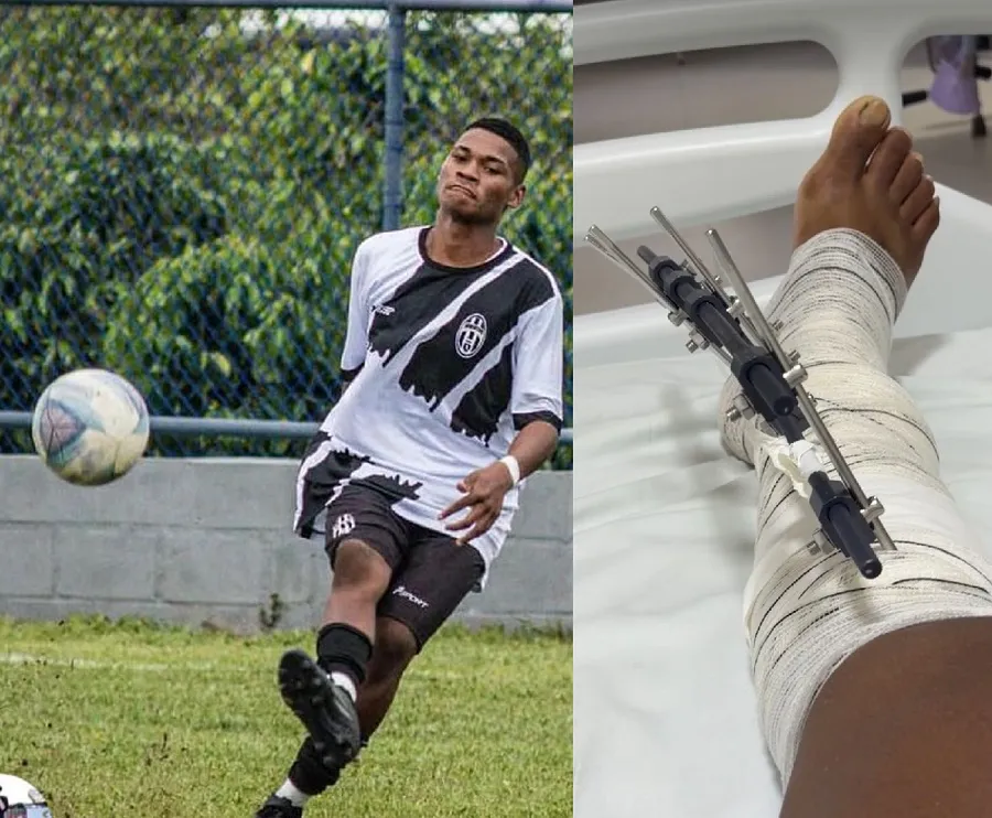 Jogador fratura tíbia durante partida de futebol em Sooretama. Amigo pede ajuda