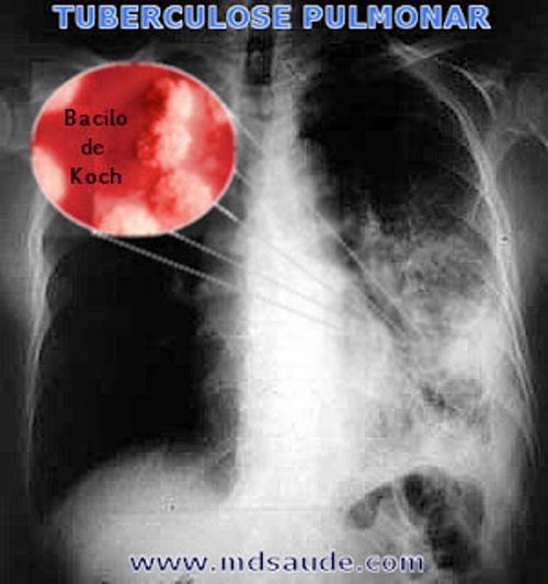 Detalhes sobre a Semana Nacional de Mobilização e Luta Contra a Tuberculose