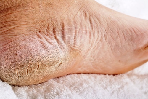 Calcanhares secos e rachados? Confira receitas de cremes caseiros