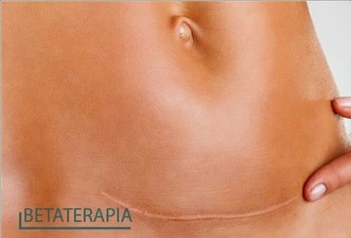 Conheça a técnica que previne cicatrizes e queloides